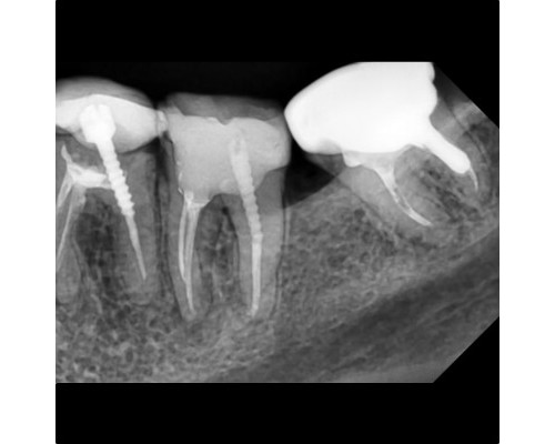 Vatech EzSensor-Радиовизиограф стоматологический 